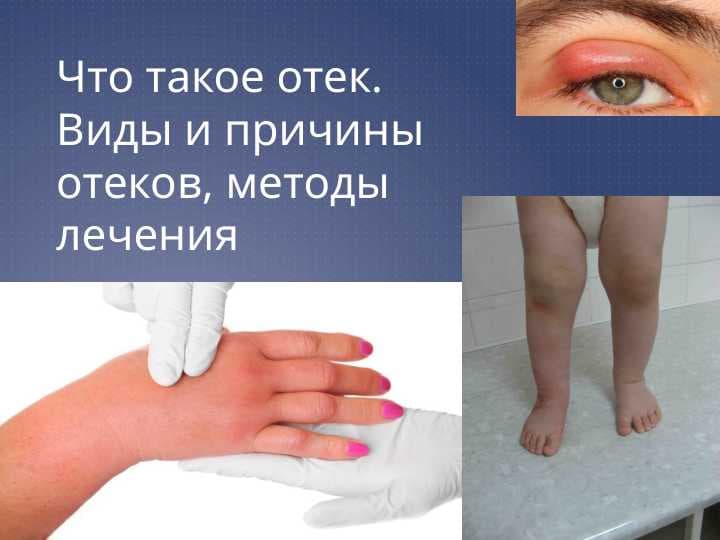Что такое отек.