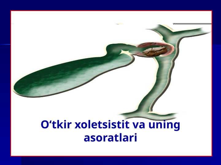 O‘tkir xoletsistit va uning asoratlari