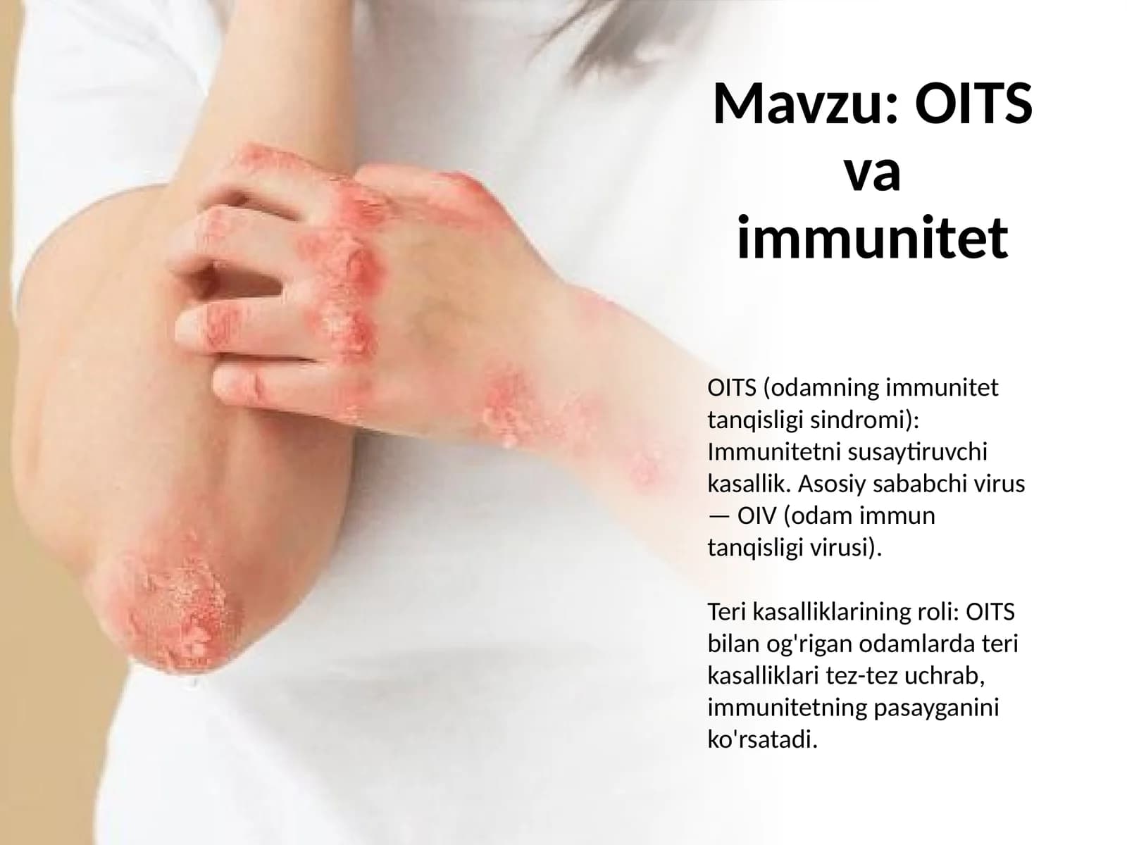 OITS va immunitet