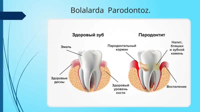 Bolalarda Parodontoz