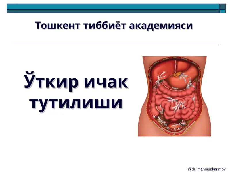 Ўткир ичак тутилиши