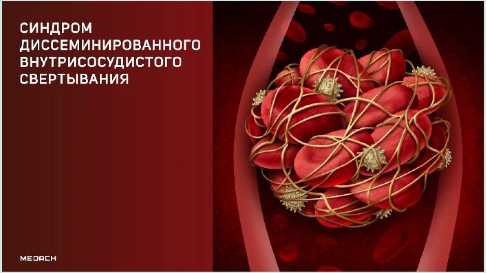 DVS sindromi