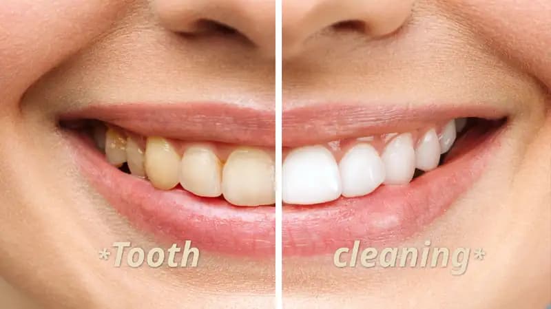 Tooth  cleaning