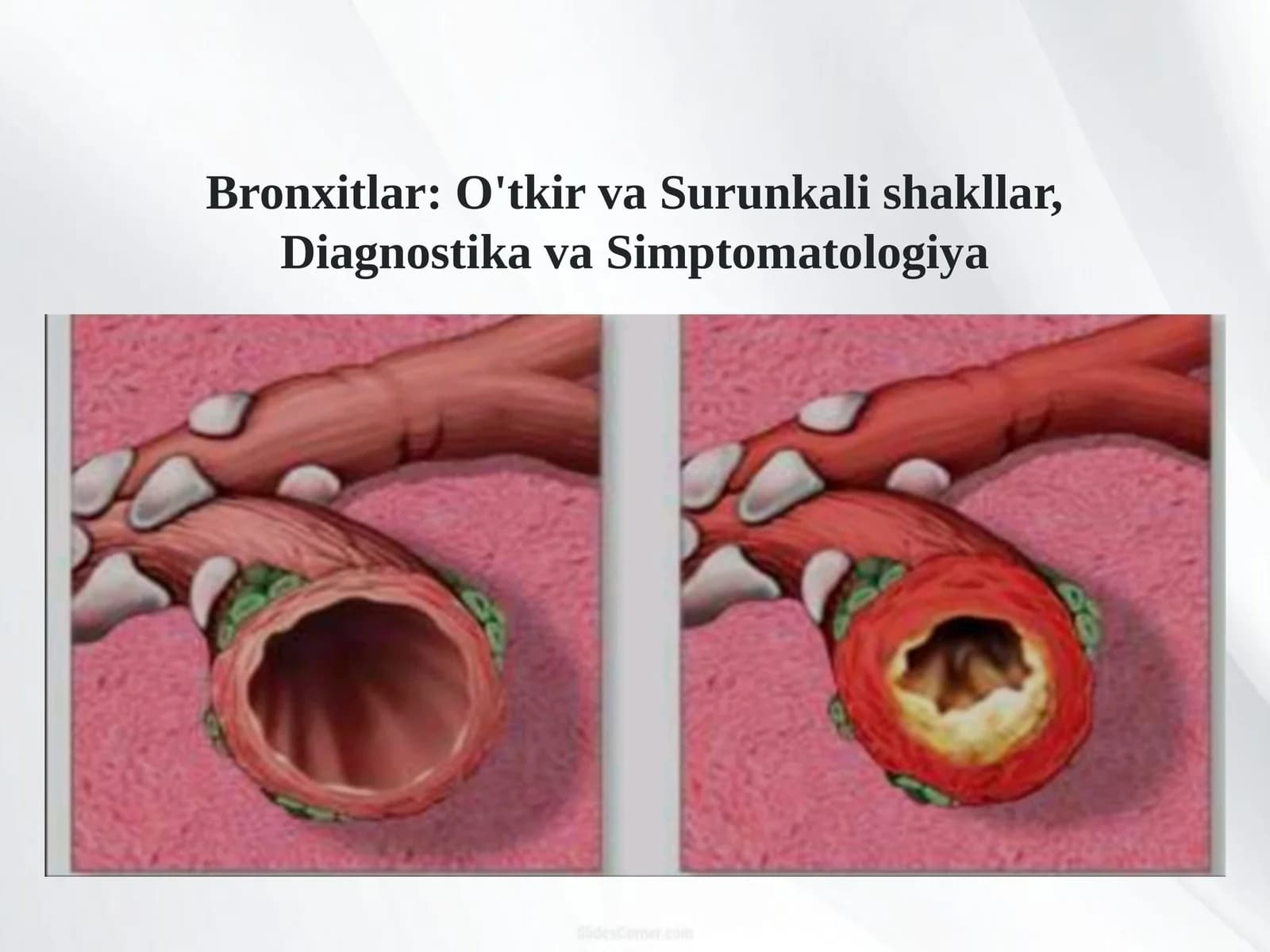 Bronxitlar (o'tkir kriteriyalari. va surunkali) simtomatologiyasi, diagnostikasi