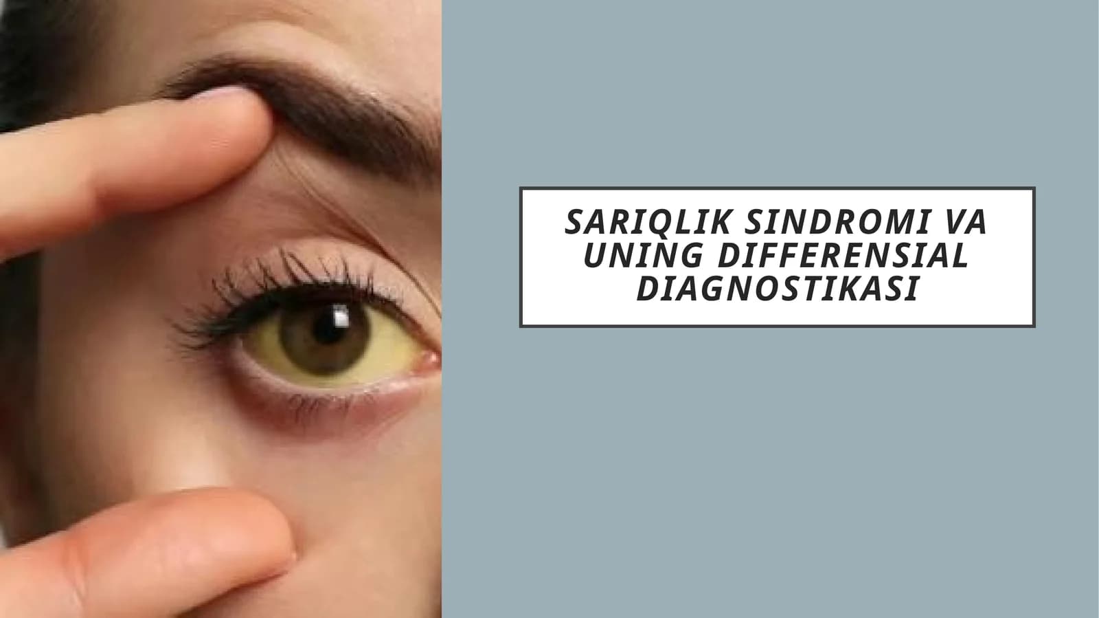 Sariqlik sindromi