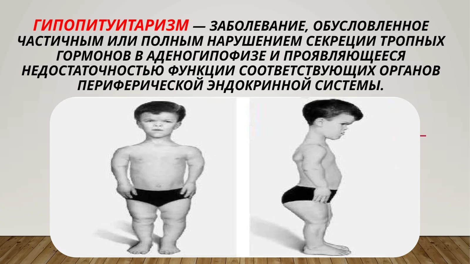 Гипопитуитаризм