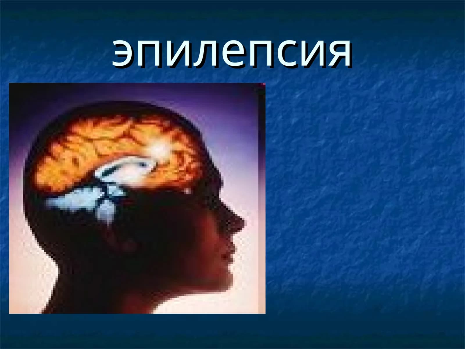 Эпилепсия