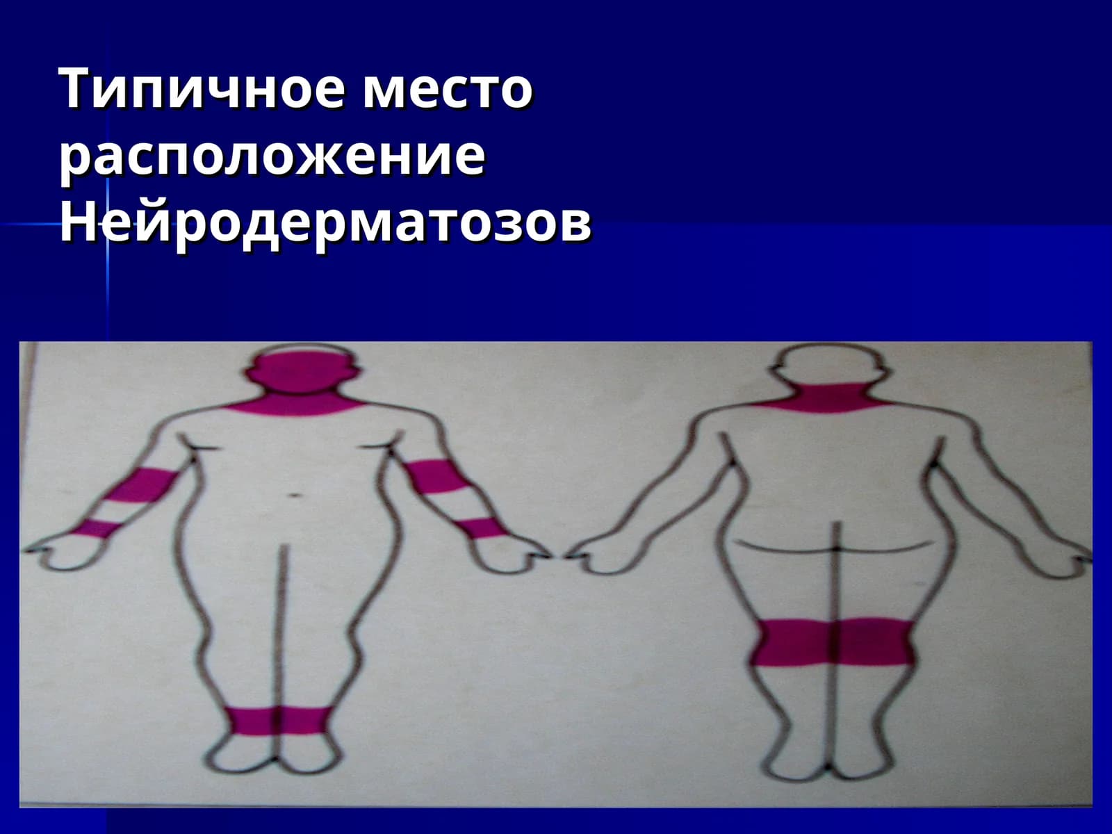 Нейродерматозов