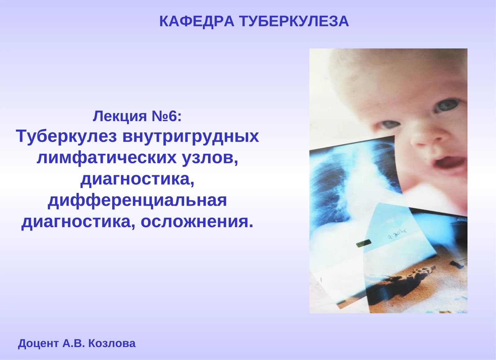 Туберкулез внутригрудных лимфатических узлов