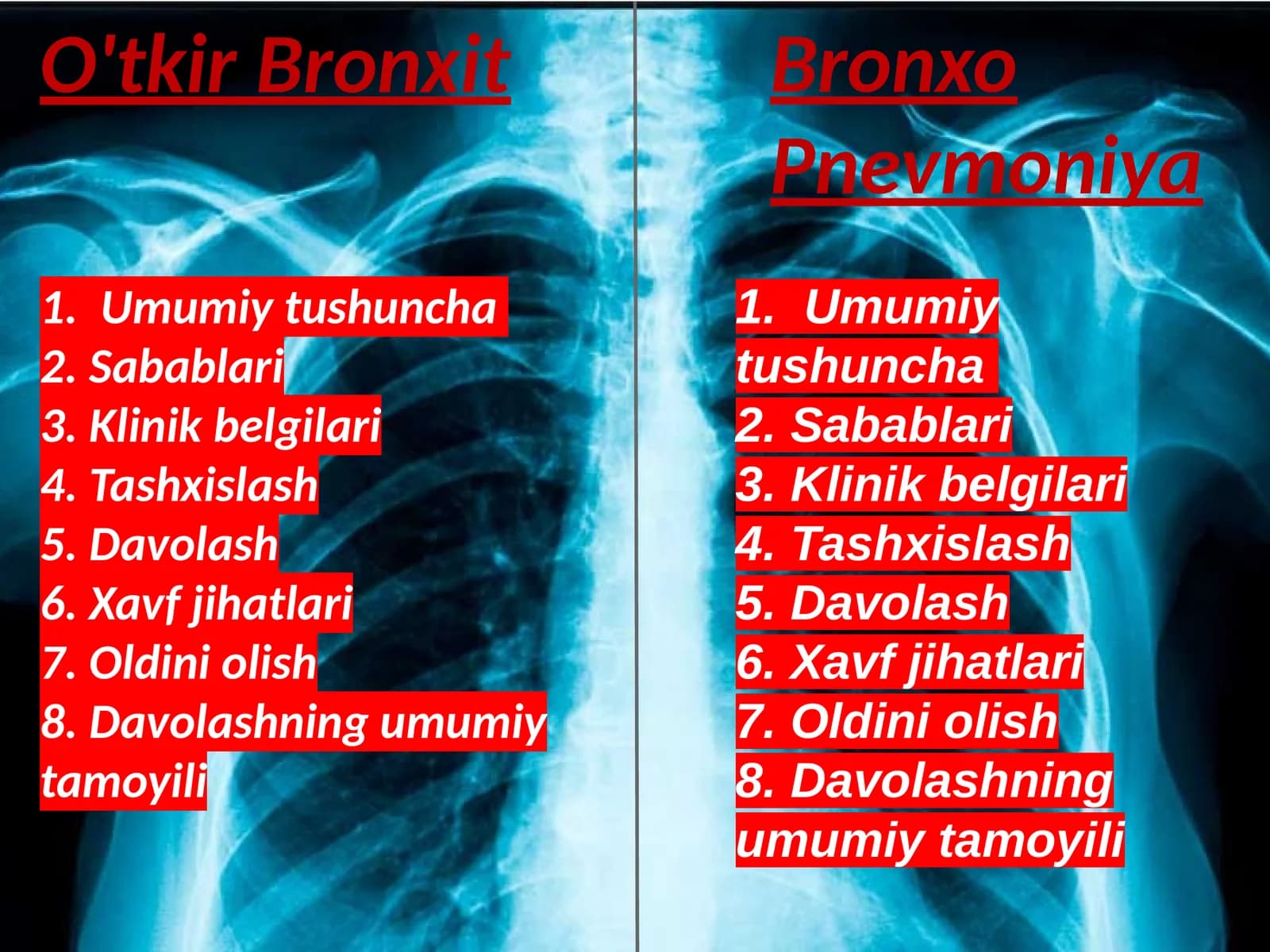 O'tkir bronxit va bronxo pnevmoniya