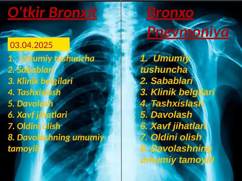 O'tkir bronxit