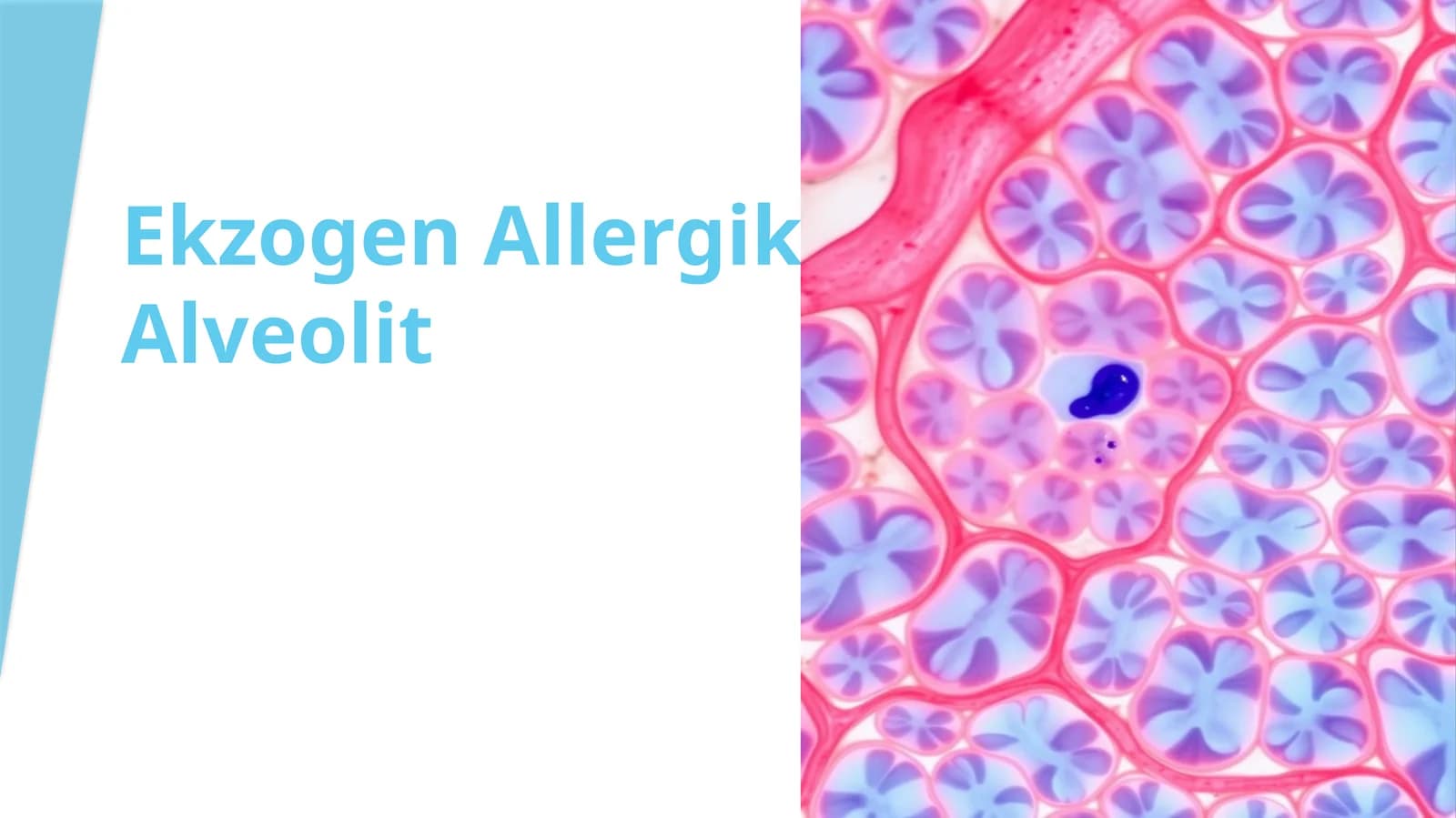 Ekzogen Allergik Alveolit