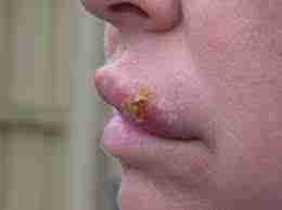 Герпес (Herpes simplex)