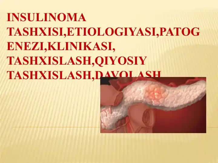 INSULINOMA TASHXISI, ETIOLOGIYASI, PATOGENEZI, KLINIKASI