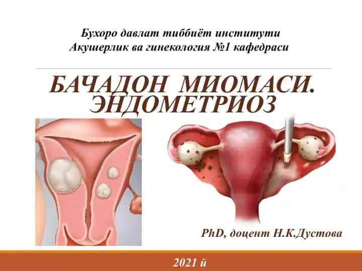 Бачадон миомаси
