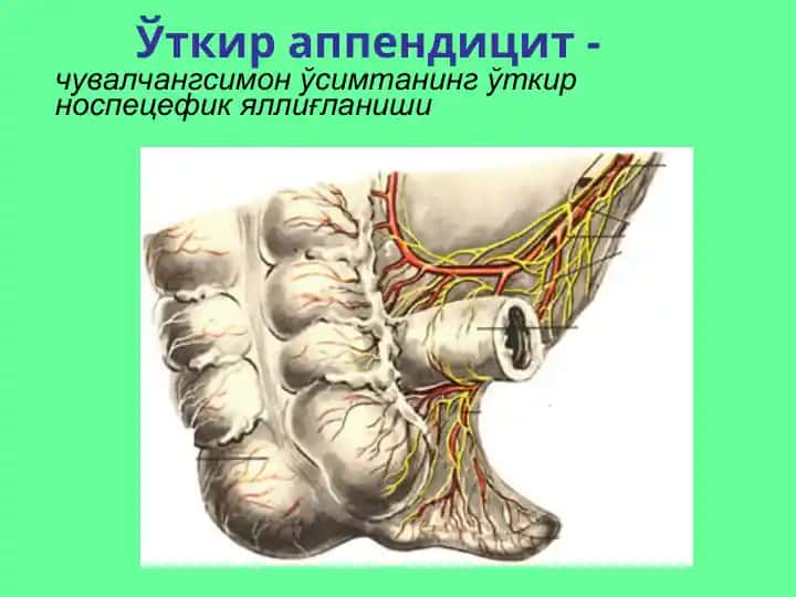 Ўткир аппендицит
