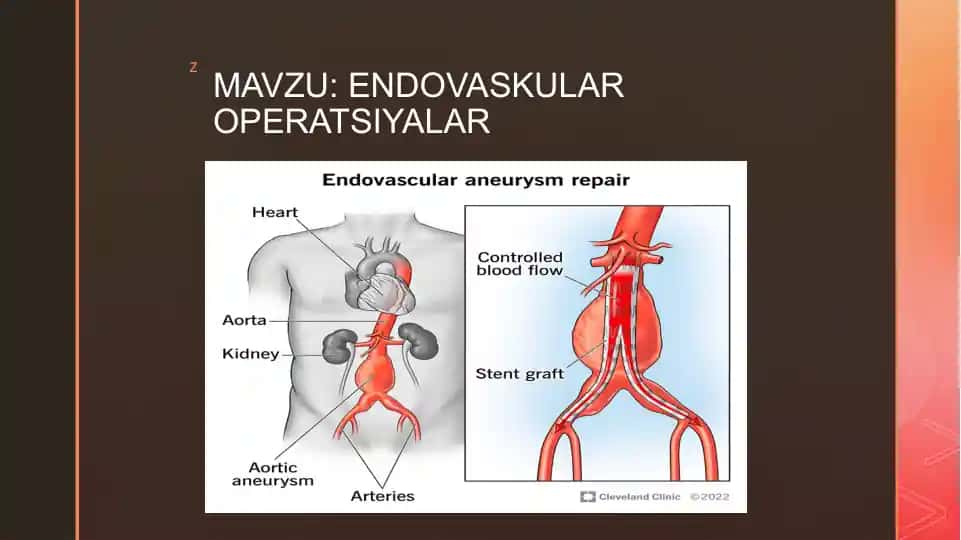 ENDOVASKULAR OPERATSIYALAR