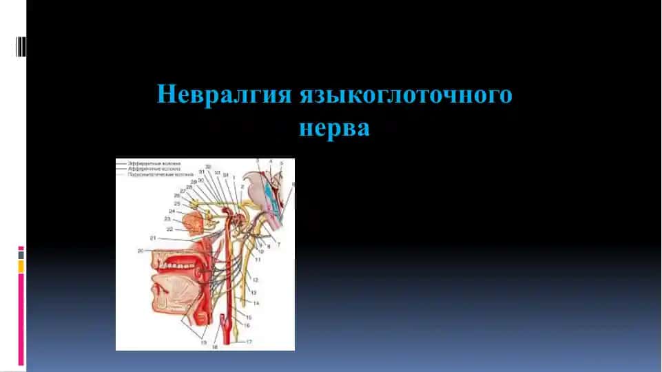 Невралгия языкоглоточного нерва