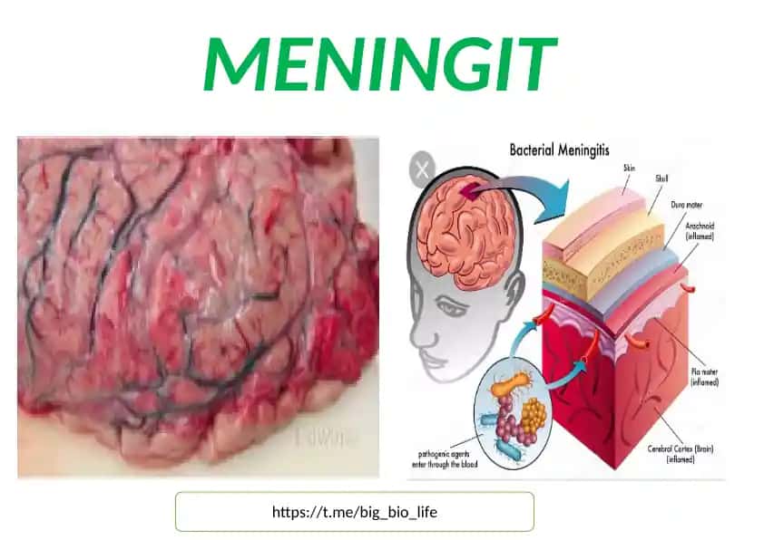 MENINGIT VA ENSEFALIT TO'G'RISIDA RASMLAR TO'PLAMI