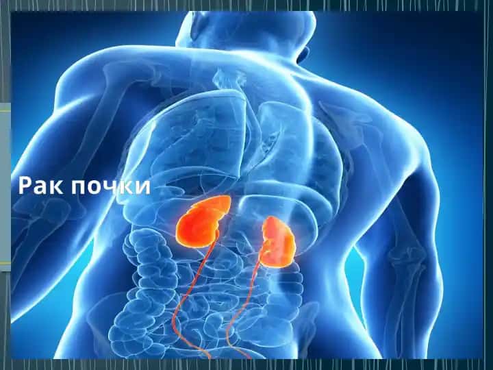 Рак почки