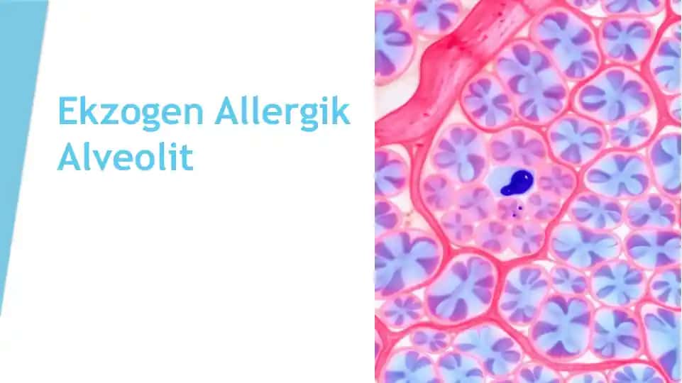 Ekzogen Allergik Alveolit