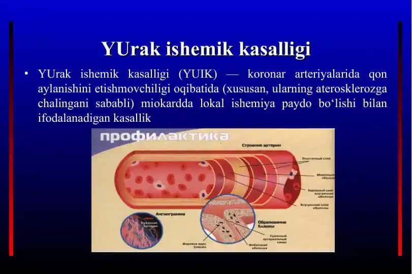 YUrak ishemik kasalligi