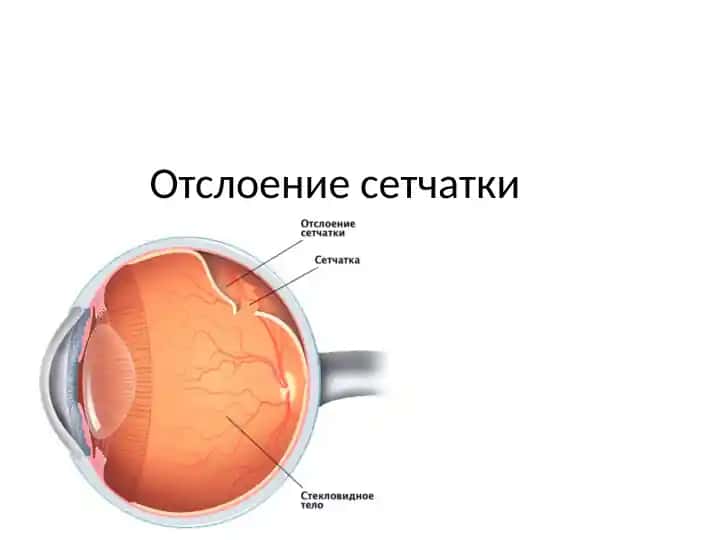 Отслоение сетчатки