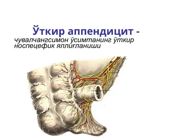 Ўткир аппендицит - чувалчангсимон ўсимтанинг ўткир носпецефик яллиғланиши
