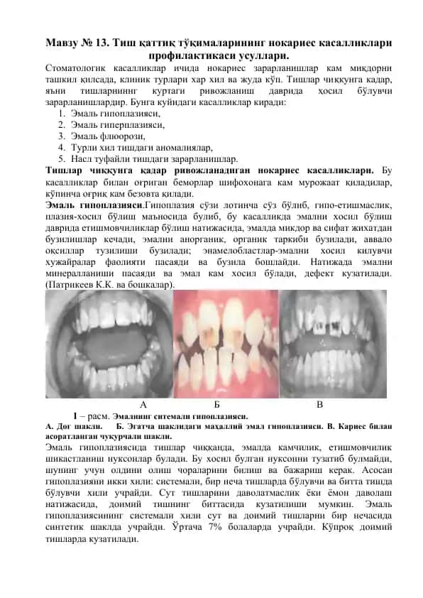 Эмаль гипоплазияси