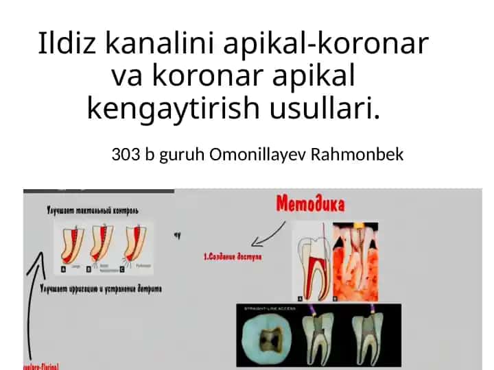 Ildiz kanalini apikal-koronar vakoronar apikal kengaytirish usullari