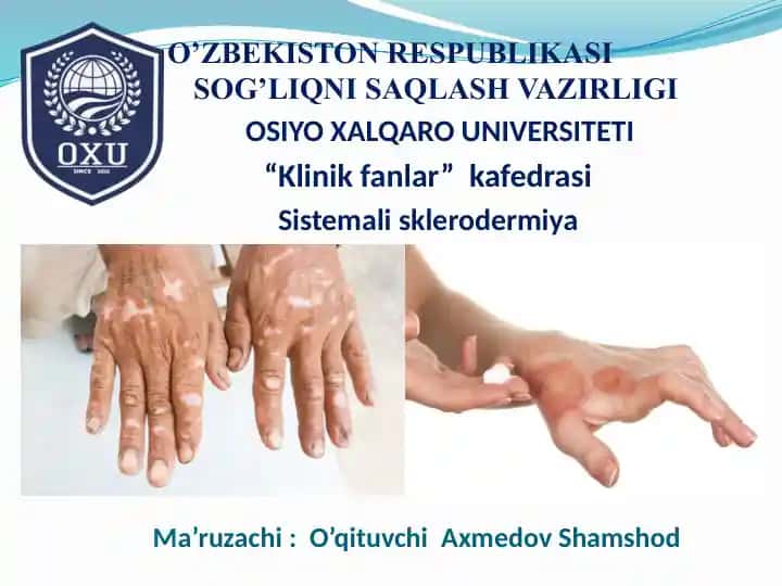 Sistemalisklerodermiya