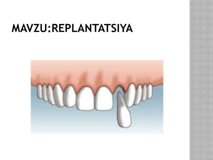Replantatsiya