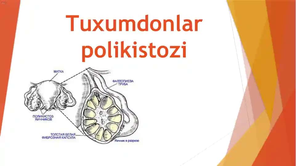 Tuxumdonlar polikistozi