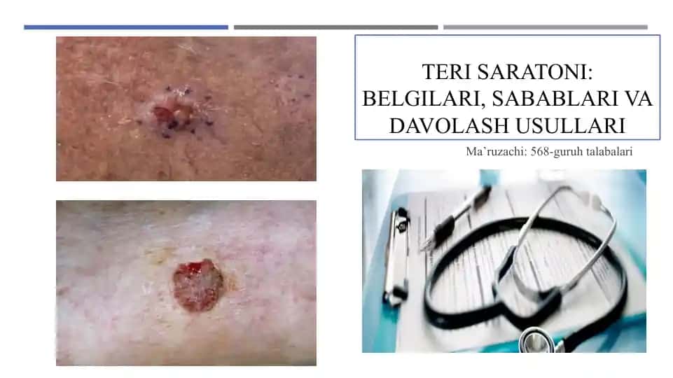 Teri saratoni malumoti
