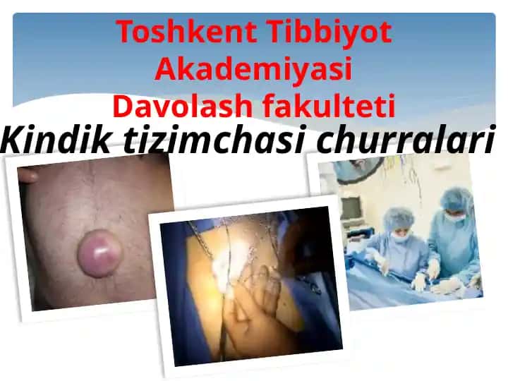 Toshkent Tibbiyot Akademiyasi Davolash fakulteti Kindik tizimchasi churralari