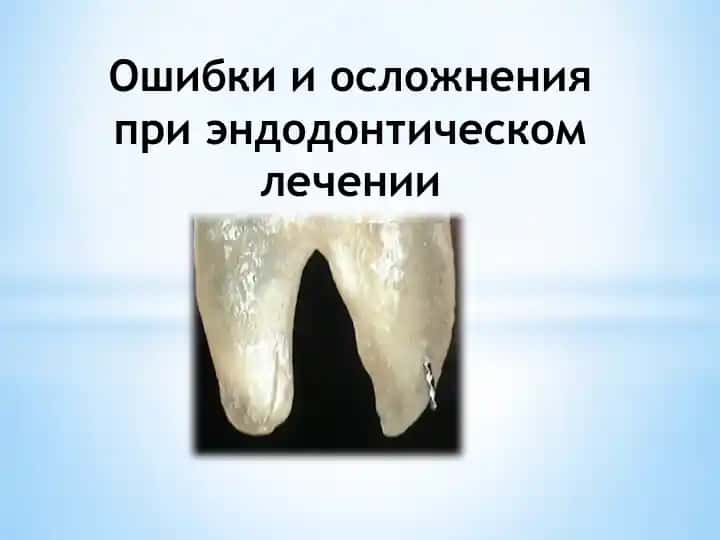 Ошибки и осложнения при эндодонтическом лечении