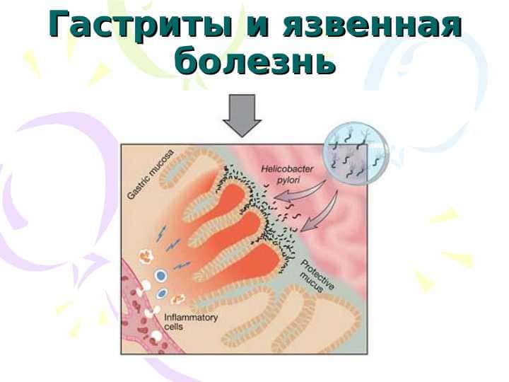 Гастритов и язвенная болезнь