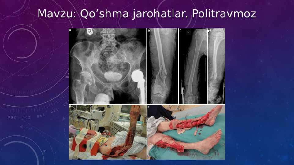 Qo‘shma jarohatlar. Politravmoz