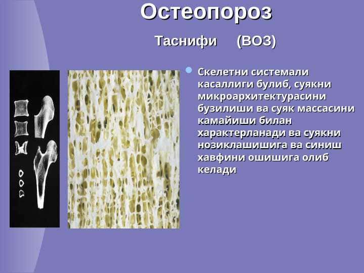Остеопороз