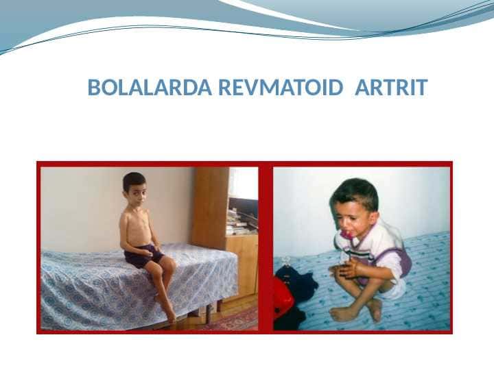 BOLALARDA REVMATOID ARTRIT