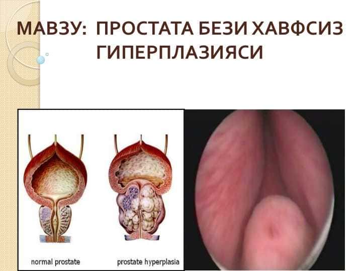 Slayd
Prostata bezi xavsiz giperplaziyasi