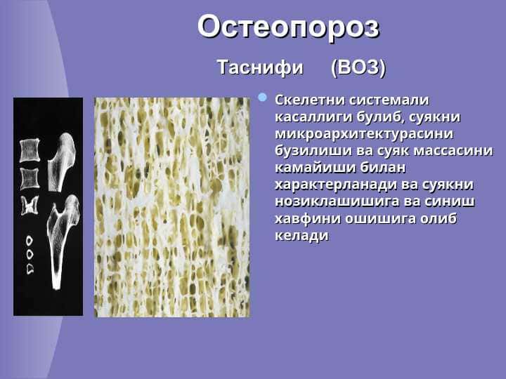 Остеопороз