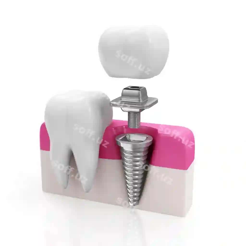 Sog'liq tish implanti | Health tooth dental implant