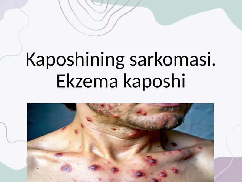 Kaposhining sarkomasi. Ekzema kaposhi
