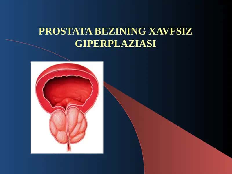 PROSTATA BEZININGXAVFSIZ GIPERPLAZIASI