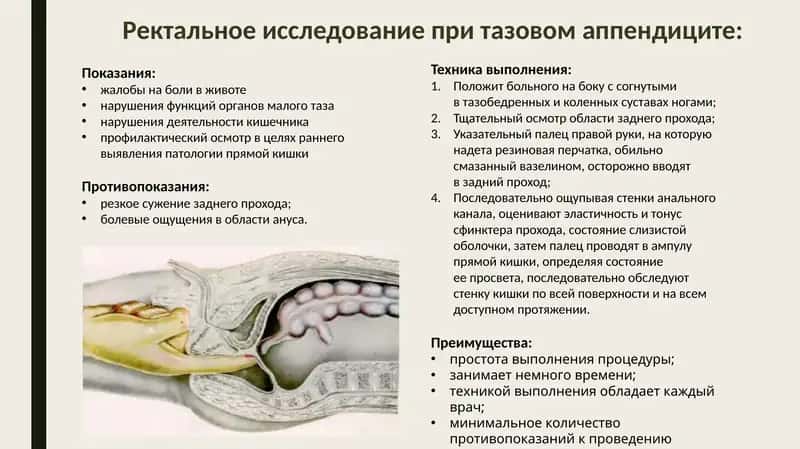Ректальное исследование при тазовом аппендиците